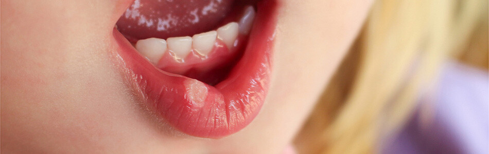 Afte u ustima - 3 načina da pomognete detetu
