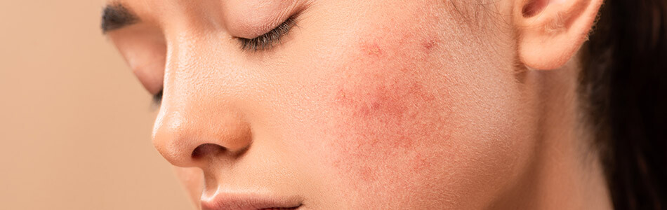 Nega osetljive kože - smanjite mogućnost iritacija