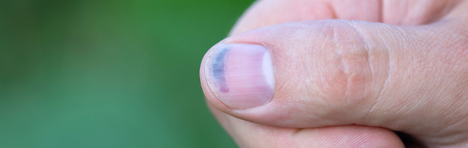 Šta nam fleke na noktima govore o zdravlju?