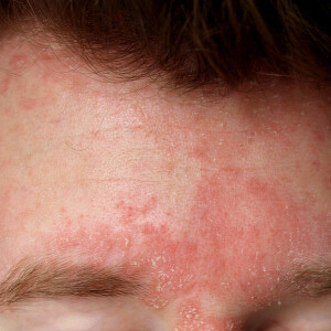 Seboroični dermatitis - kako ublažiti simptome