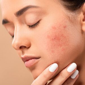 Nega osetljive kože - smanjite mogućnost iritacija