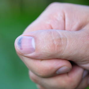 Šta nam fleke na noktima govore o zdravlju?